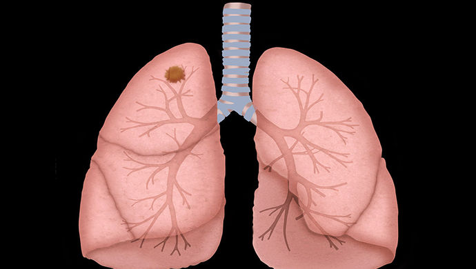 小小肩背疼痛却被查出肺癌骨转移 谁说肺癌发