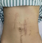 手术拉链怎么拆“拉链腹”患者肠套叠苦不堪言，中山医院内镜团队巧用小肠镜切除巨大息肉_https://www.jmylbn.com_新闻资讯_第1张