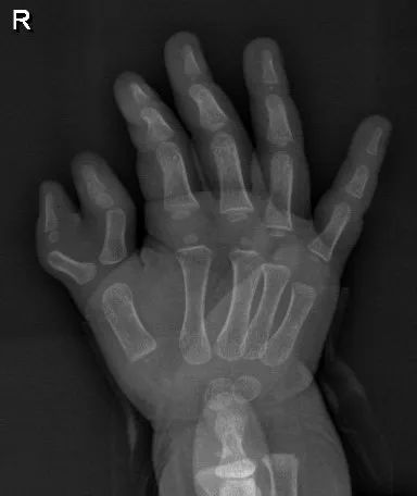 幼童一出生长了六指蟹钳手医生巧思拼好了