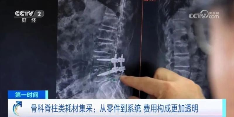 手术耗材是什么多地骨科脊柱类耗材集采中选结果落地！平均降价84%，一年能省260亿元_https://www.jmylbn.com_新闻资讯_第6张