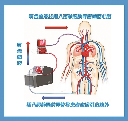 "人工肺"真是救命神器吗