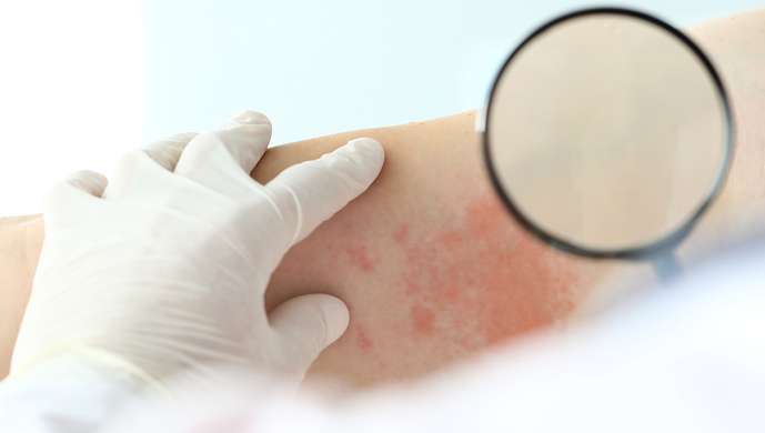 我国50岁以上人群每年新发带状疱疹156万人,"缠腰龙"为何这么痛?