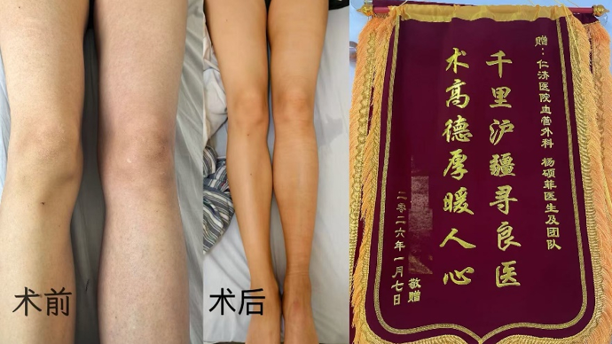 32岁女子“大象腿”无法行走被迫卧床，上海医生2毫米微创“清理”血管