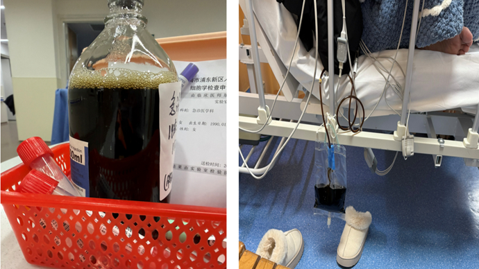 春节接诊35岁“非典型”胰腺炎，急诊医生说：这些信号千万不能忽视