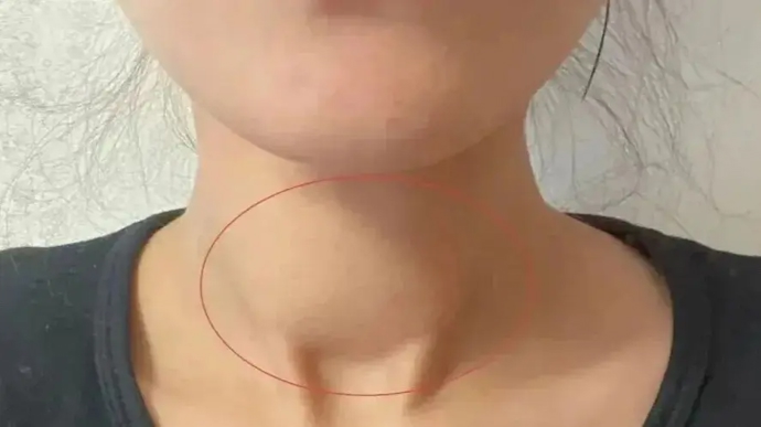 32岁女子感冒后多器官“罢工”，潜藏20年，突然大爆发！上海三甲医院出手