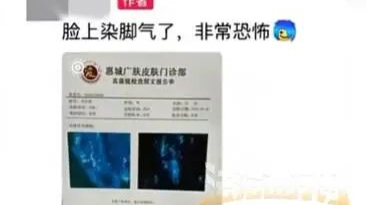男子健身后直接用手擦汗，脸上竟感染“脚气”，直呼太恐怖！