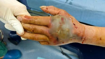 男子杀死剧毒眼镜蛇，5分钟后蛇头突然“复仇”，毒牙刺入其掌心！医生提醒